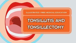 What is Tonsillitis amp Tonsillectomy [upl. by Soilissav]