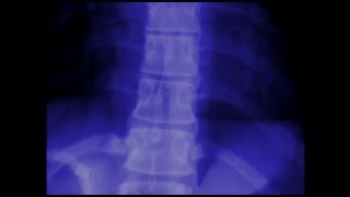 Areas of Inflammation in Ankylosing Spondylitis [upl. by Effy]