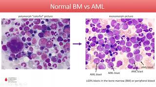 Acute Myeloid Leukemia  Diagnosis and Treatment in 2020 [upl. by Mendel172]