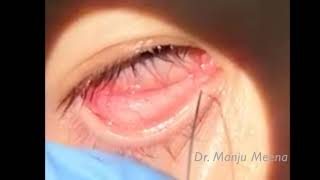 Lacrimal Syringing [upl. by Boys]