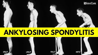 What is Ankylosing Spondylitis Causes Symptoms and Diagnosis EXPLAINED [upl. by Nnaes]