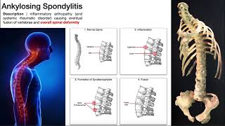 Ankylosing Spondylitis  Mechanism Risk Factors amp SignsSymptoms [upl. by Lucretia605]