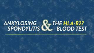 HLAB27 An Important Genetic Marker for Ankylosing Spondylitis [upl. by Noevad]