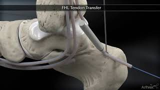 Flexor Hallucis Longus FHL Tendon Transfer [upl. by Tristas]