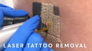 Laser Tattoo Removal PAIN RESULTS amp PROCEDURE [upl. by Crispin]