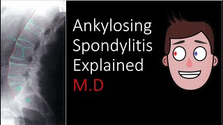 Ankylosing Spondylitis Explained [upl. by Noivad155]