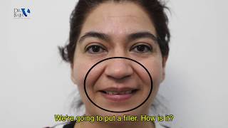 ¡IMPRESIONANTE El efecto inmediato de rellenos faciales  Dr Baja [upl. by Fishman441]