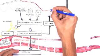 Burns  Pathophysiology [upl. by Hugon39]