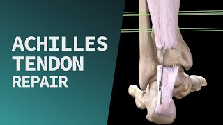 Achilles Tendon Repair [upl. by Nnanerak]