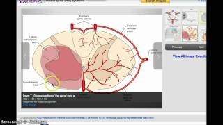 Vascular EhlersDanlos Syndrome vEDS [upl. by Enaamuj]