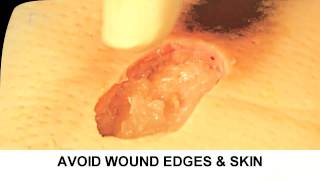 Enzymatic Debridement Demonstration Understand Wound Care [upl. by Selima]