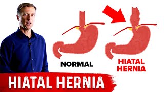 Hiatal Hernia Causes Symptoms Diagnosis Treatment [upl. by Nilyahs874]