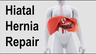 Hiatal Hernia Repair Animation [upl. by Irrac]