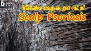 Scalp psoriasisSymptom Cause Treatment  Safe ways to Wash Hair Dr Rasya Dixit Doctors Circle [upl. by Charmaine]