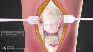 Patella Tendon Repair [upl. by Tomi]