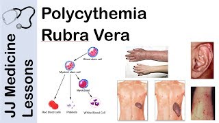 Polycythemia Rubra Vera  Pathophysiology Symptoms Diagnosis and Treatment [upl. by Eirok]