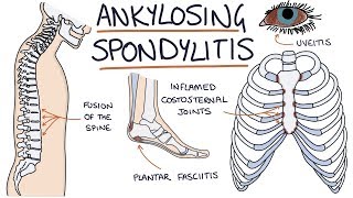 Ankylosing Spondylitis Visual Explanation for Students [upl. by Ielhsa107]