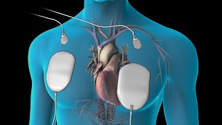 Cardioversion for Atrial Fibrillation [upl. by Enitsirc]