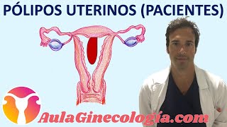 PÓLIPOS UTERINOS PACIENTES Síntomas diagnóstico y tratamiento  Ginecología y Obstetricia [upl. by Cadmarr]