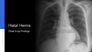 Hiatal Hernia Diagnosis and Tests [upl. by Rafaelia]