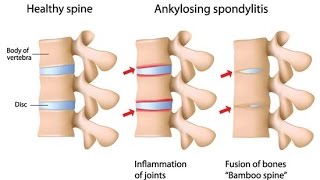 Ankylosing Spondylitis [upl. by Bendicta]