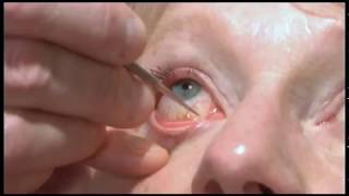 Oculoplastics basic exam Lacrimal system examination [upl. by Rona]