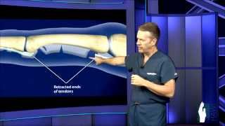 Flexor Tendon Surgery [upl. by Wolsniw]