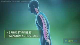 Ankylosing Spondylitis Symptoms [upl. by Linnell937]