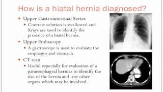 Hiatal Hernias [upl. by Coffee150]