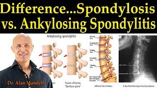 The Difference Between Spondylosis amp Ankylosing Spondylitis  Dr Alan Mandell DC [upl. by Yrallih]