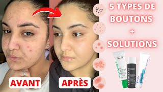 LACNÉ  MA ROUTINE SKINCARE  TOUTES LES SOLUTIONS POUR CHAQUE TYPE DE BOUTON [upl. by Nilsoj]