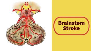 Brainstem Stroke Syndromes [upl. by Rezzani]