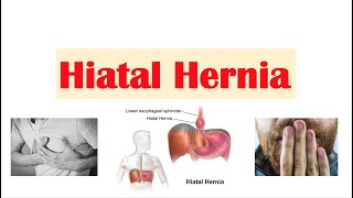 Hiatal Hernia Treatment Options [upl. by Olodort]