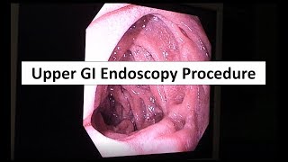 Upper GI Endoscopy Procedure in the ED [upl. by Shannan]