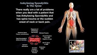 Ankylosing Spondylitis amp The Spine  Everything You Need To Know  Dr Nabil Ebraheim [upl. by Ehrlich]